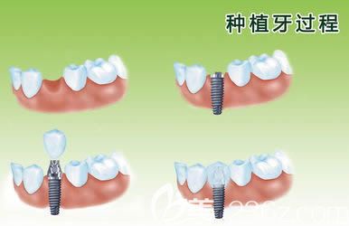 革新口腔之美——探索前沿牙齿种植新篇章